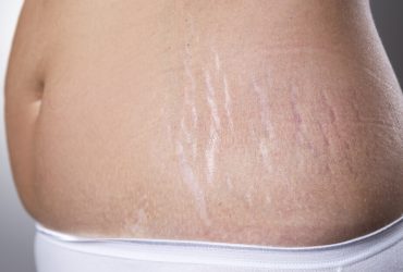 Ayurvedic Remedies To Get Rid of Stretch Marks